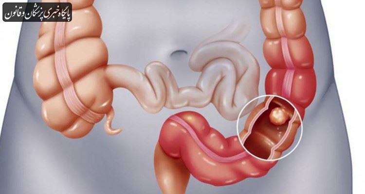 سن ابتلا به سرطان‌های دستگاه گوارش در کشور کاهش پیدا کرده است