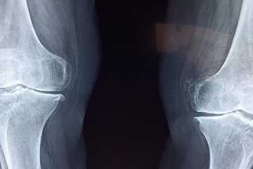 سالمندی جمعیت و چالش جدی سلامت استخوان