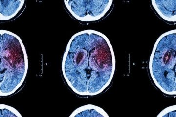 ثبت سالانه بیش از ۱۰۰ هزار سکته مغزی در کشور