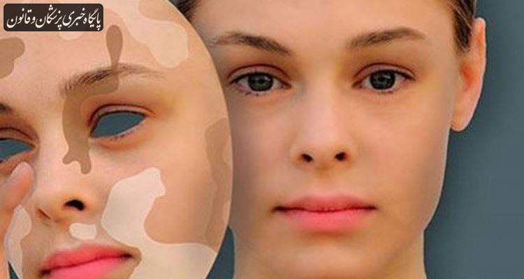 تولید نمونه داخلی یکی از داروهای موثر در درمان بیماری ویتیلیگو تولید نمونه داخلی یکی از داروهای موثر در درمان بیماری ویتیلیگو