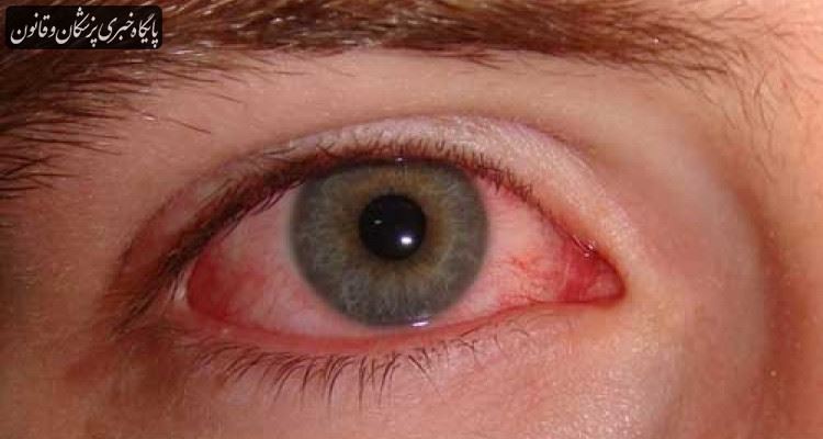 بازیابی قدرت بینایی قربانیان سوختگی‌های شیمیایی چشم