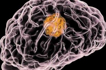 اختصاص اعتبار پژوهشی ۷.۹ میلیون دلاری برای توسعه نانوداروی ضدسرطان مغز