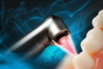 کاربرد‌های متنوع استفاده از لیزر در درمان‌های دندانپزشکی
