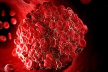 عوامل اکتسابی و ارثی ایجاد لخته های وریدی خون