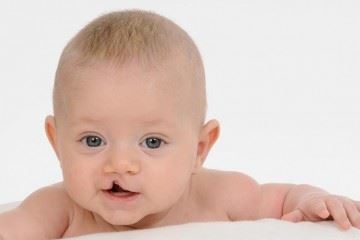شکاف لب و کام از شایع‌ترین بیماری‌های مادرزادی در ناحیه سر و صورت است