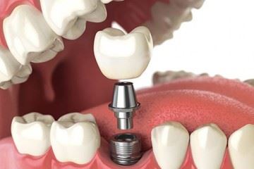 طول عمر مفید ایمپلنت‌های دندانی ۱۰ تا ۱۲ سال است
