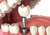 طول عمر مفید ایمپلنت‌های دندانی ۱۰ تا ۱۲ سال است