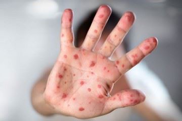 حفظ گواهینامه حذف سرخک از کسب آن بسیار مهم‌تر است