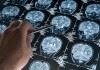 کاربرد نقشه‌برداری مغز در تشخیص بیماری‌های روان‌پزشکی و عصب‌شناختی