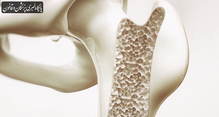 پوکی استخوان شایع‌ترین بیماری متابولیک استخوان است