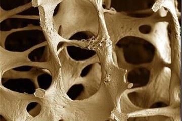 در آینده با شیوع بالاتری از استئوپروز و عواقب آن روبرو هستیم