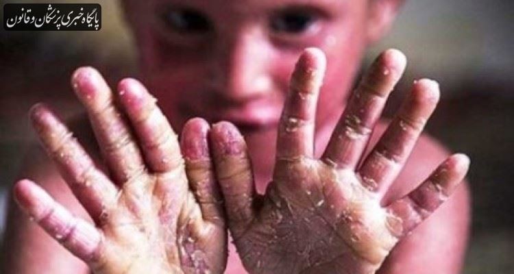 بیماران ای بی پانسمان به میزان مورد نیاز ندارند بیماران ای بی پانسمان به میزان مورد نیاز ندارند