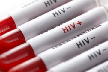 بیش از ۶۰ هزار نفر مبتلای زنده به ایدز در کشور داریم