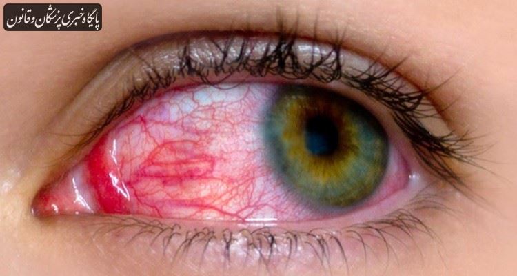 ماجرای شیوع ویروس چشمی در کشور